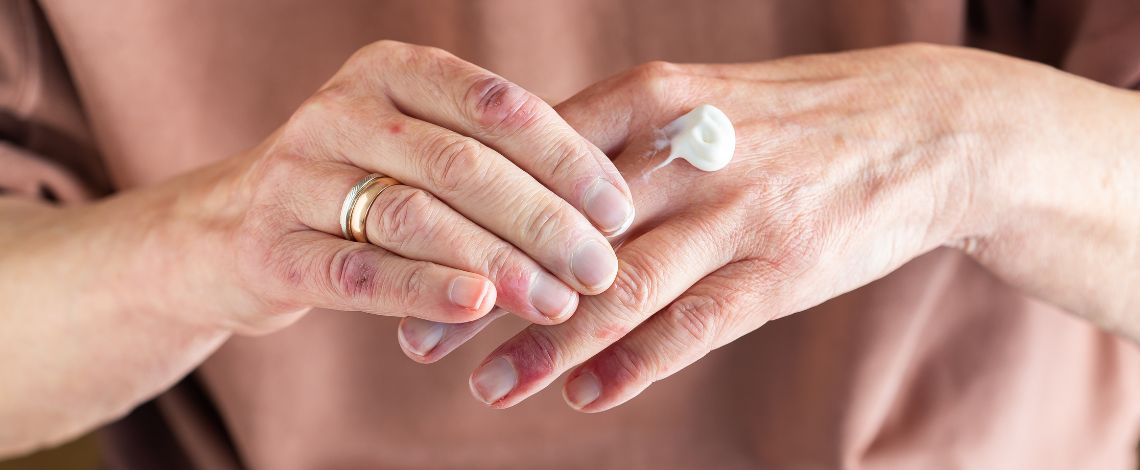 Atopijski dermatitis kod odraslih  kako si moemo pomoi