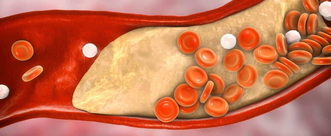 Što je ateroskleroza i zašto nastaje